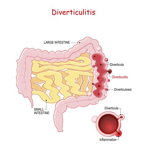 diverticulosis icd-10|Diverticulosis: What It Is, Symptoms, Causes & Treatment